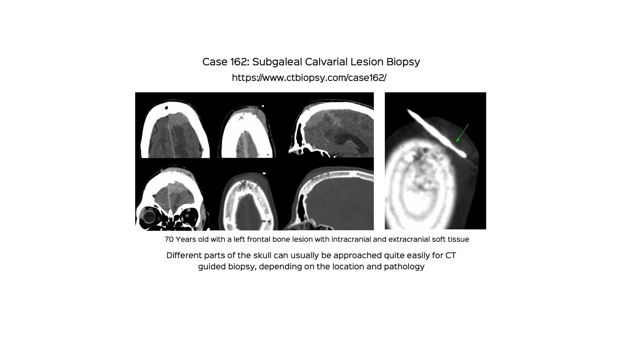 Case 162: Subgaleal Calvarial Lesion Biopsy