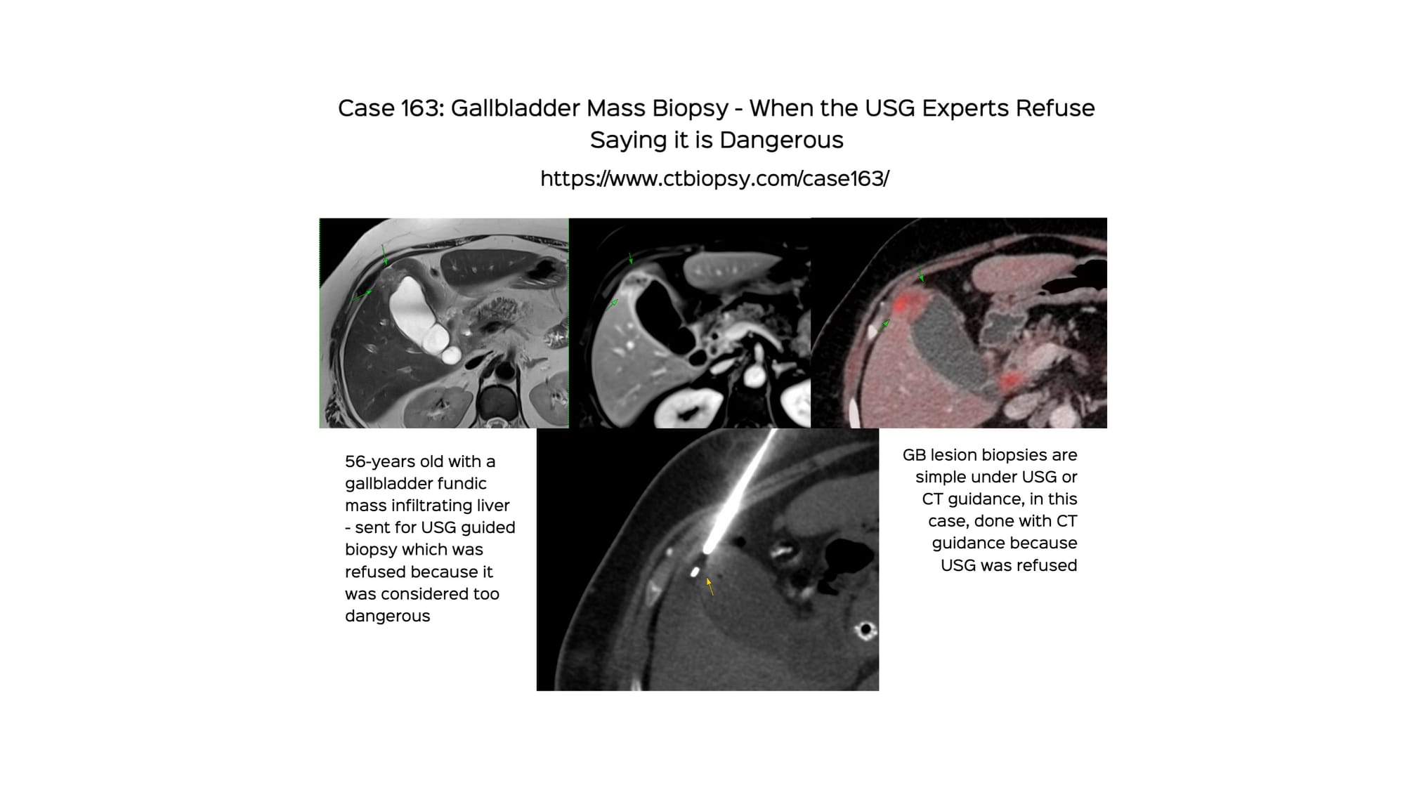Case 163: Gallbladder Mass Biopsy - When USG Experts Say it is Risky to Biopsy