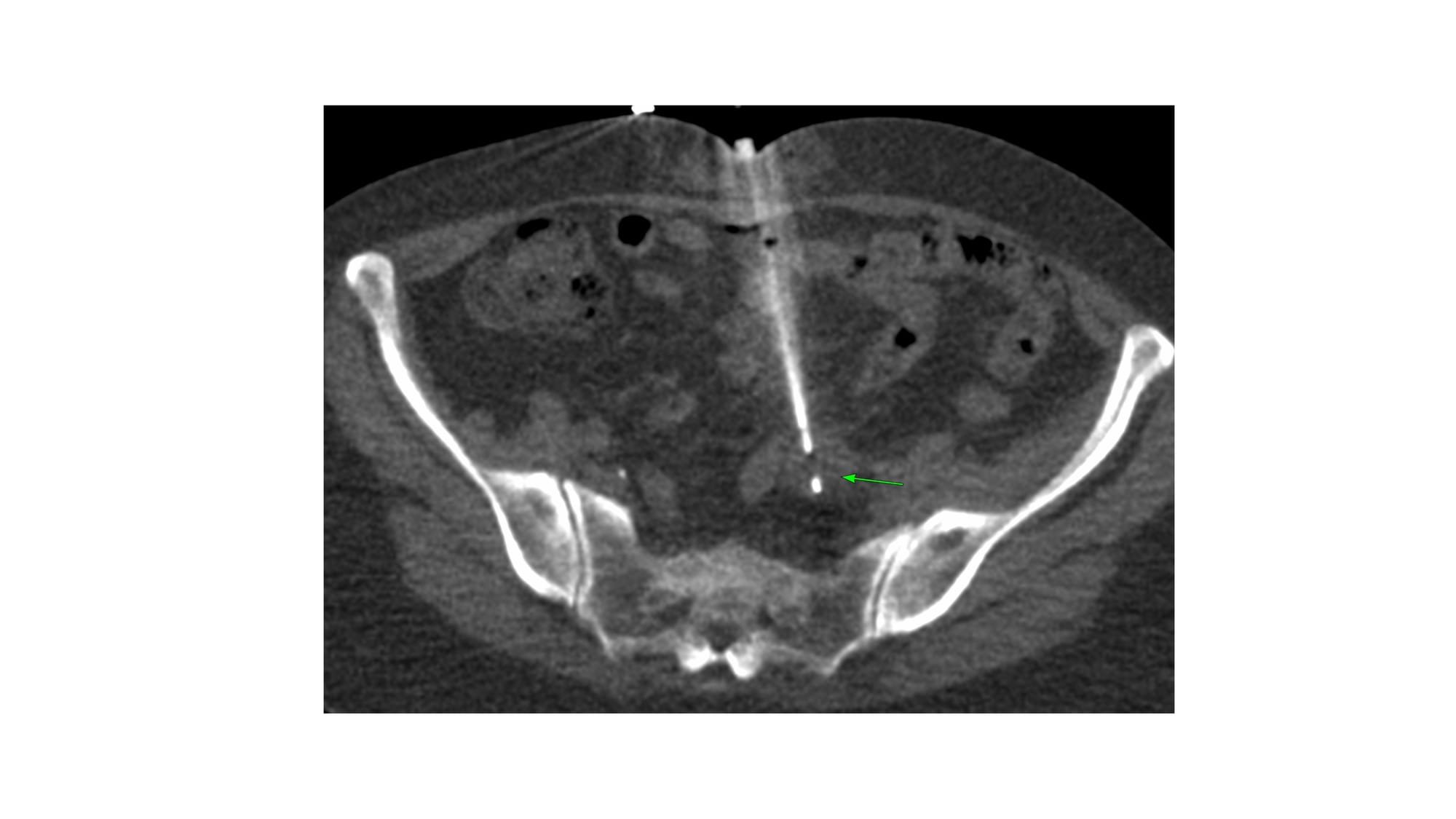 Case 164: Parting of the Bowel Loops with a Blunt-Tip