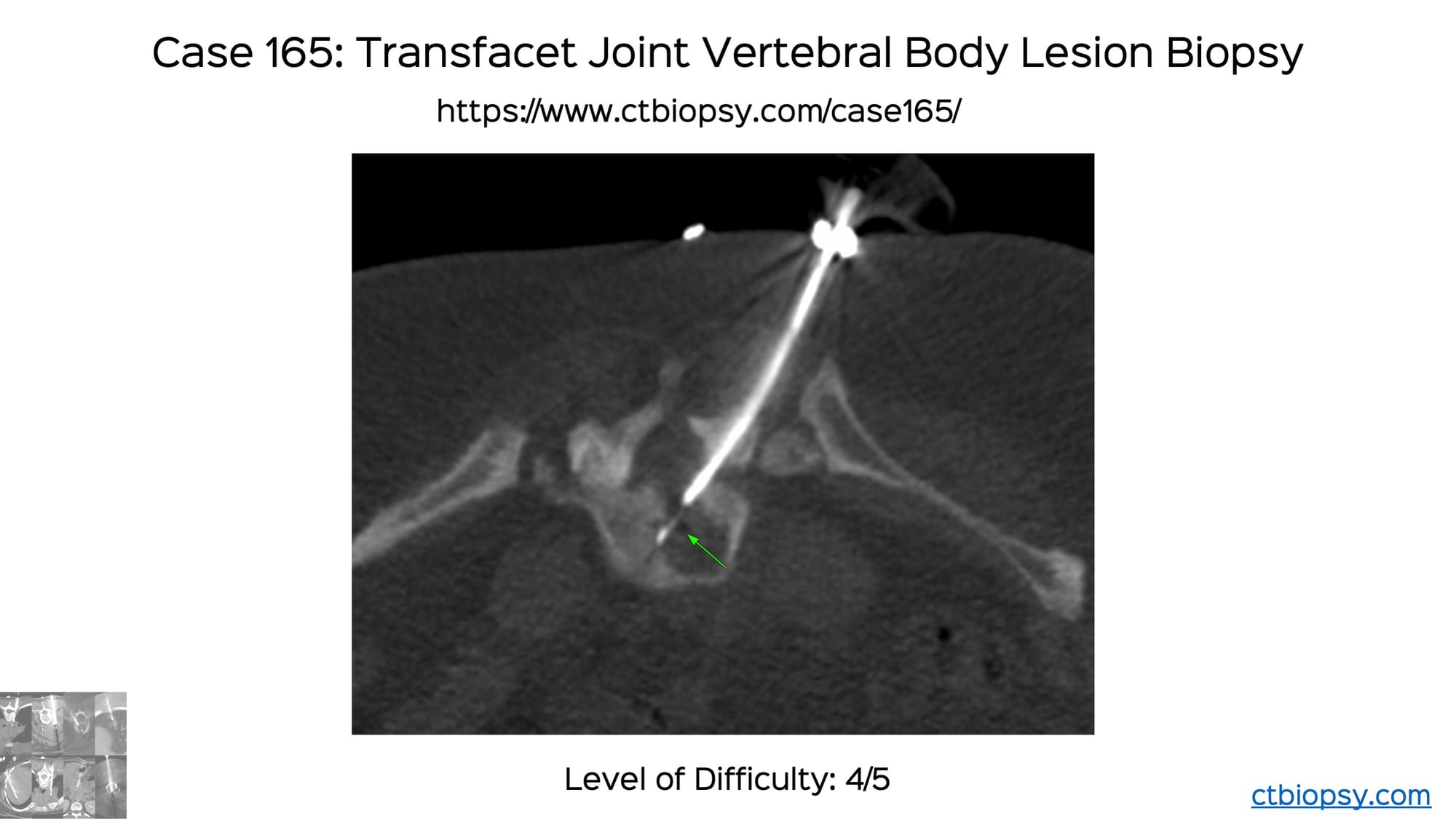 Case 165: Transfacet Joint Vertebral Body Lesion Biopsy