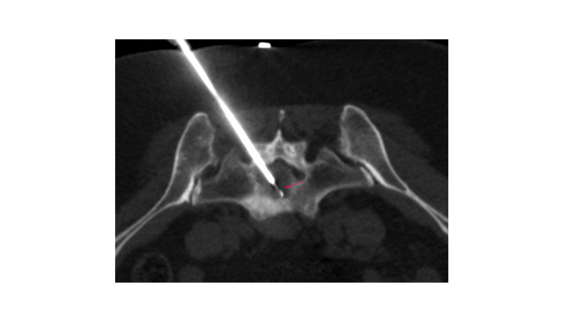 Case 166: Translaminar Vertebral Body Lesion Biopsy