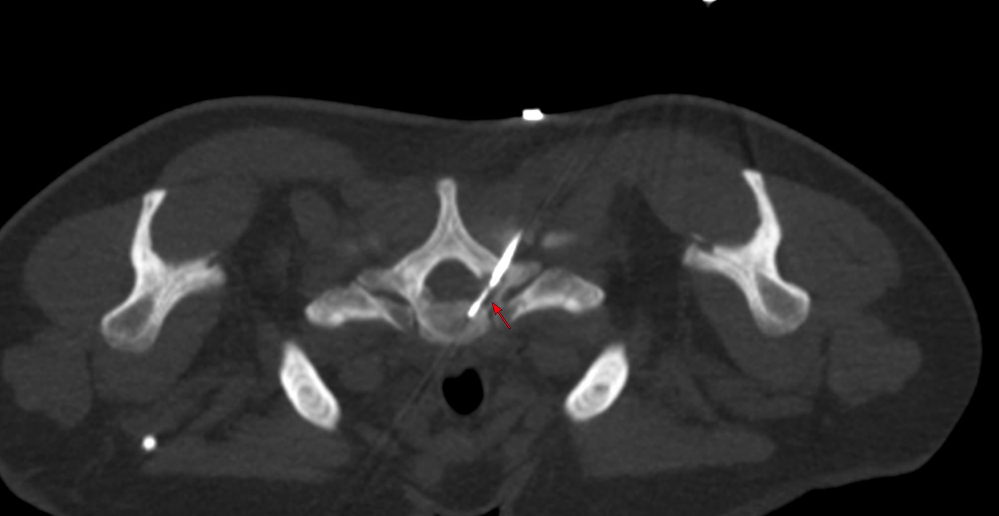 Case of the Day 100 - 2025 09 10 - T2 Dark Thoracic Spinal Vertebral Lesion - Transpedicular Biopsy