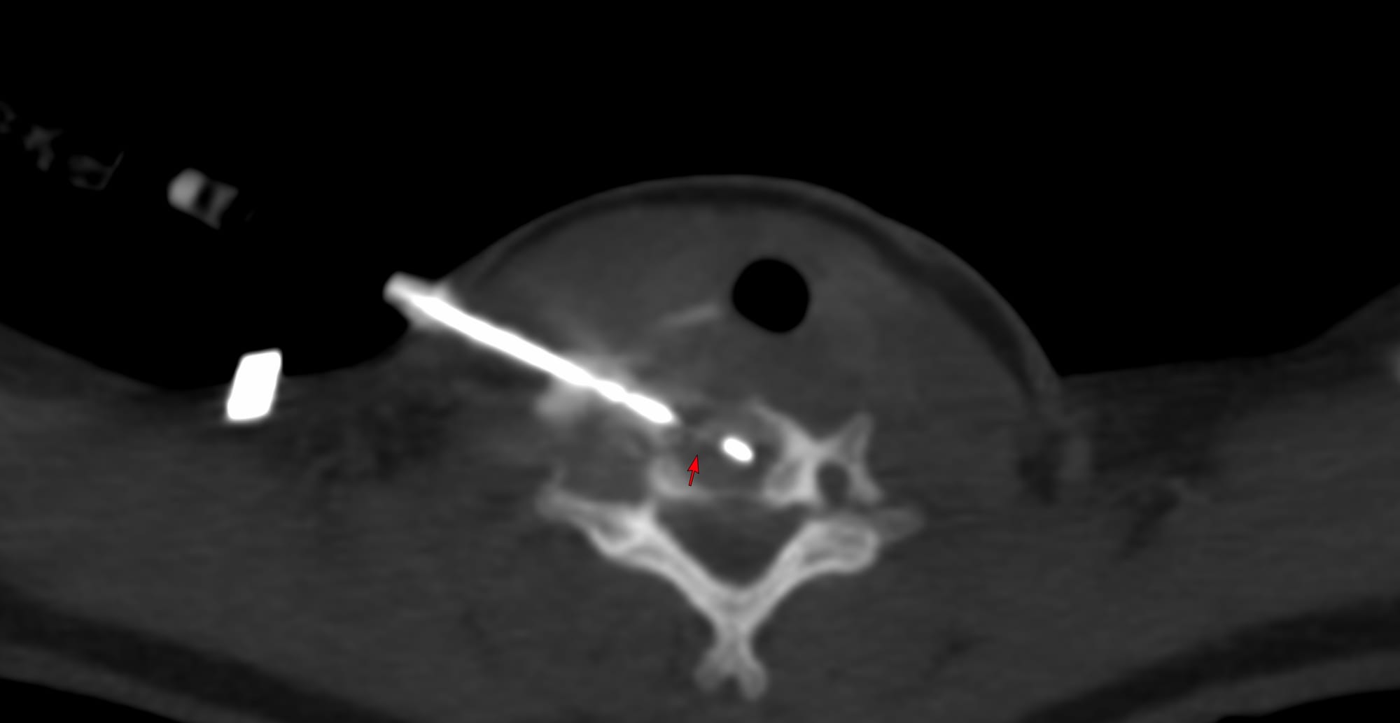 Case of the Day - 098 - 2025 09 08 - Confirming Tuberculosis of the Lower Cervical Spine