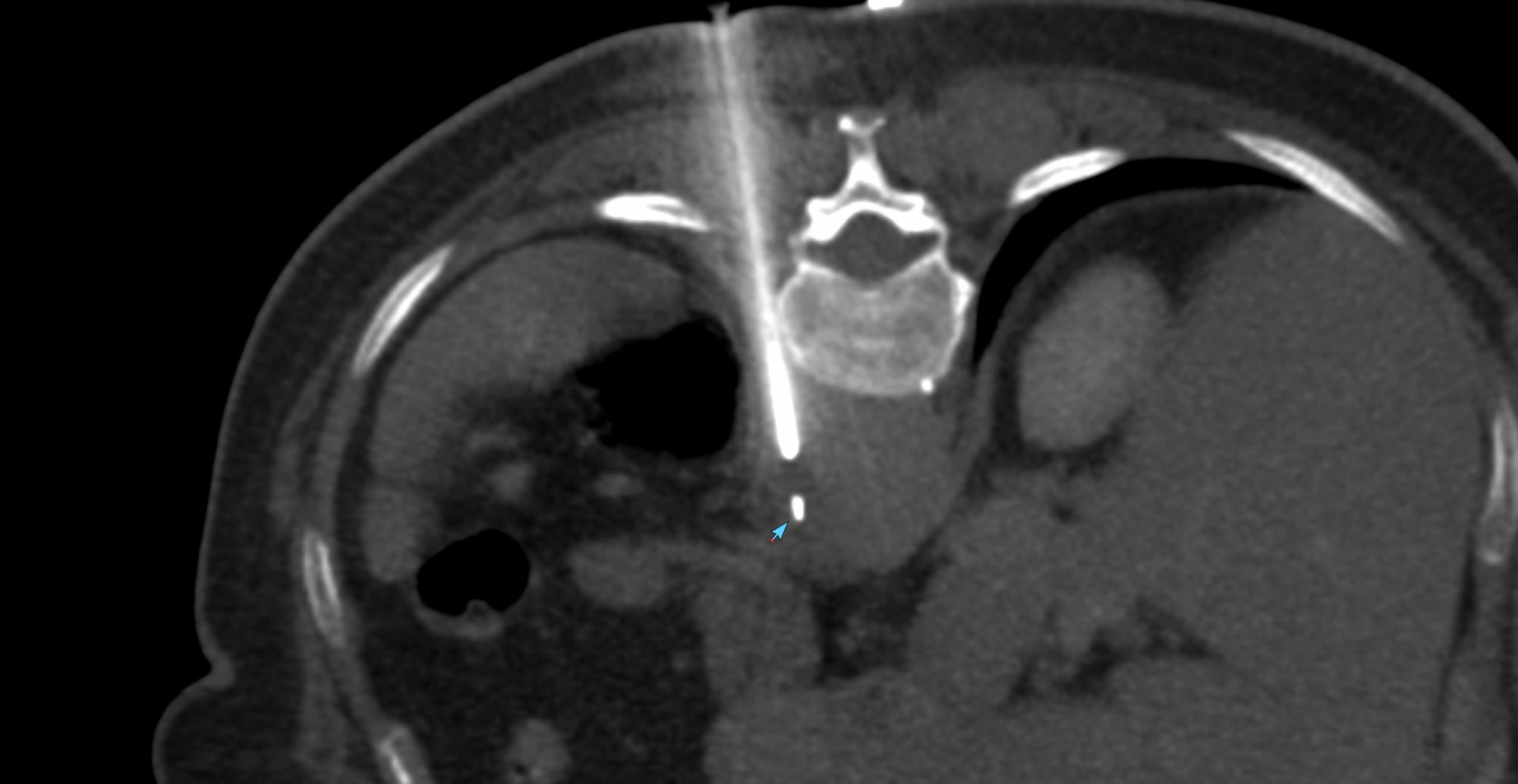Case 170 - Peri-Aortic Soft Tissue Biopsy