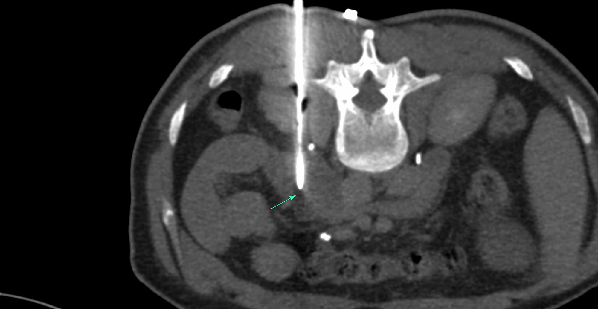 Case of the Day 106 - 2025 09 22 - Retroperitoneal Posterior Parapsoas Approach - Macrocystic Lymphatic Malformation Aspiration