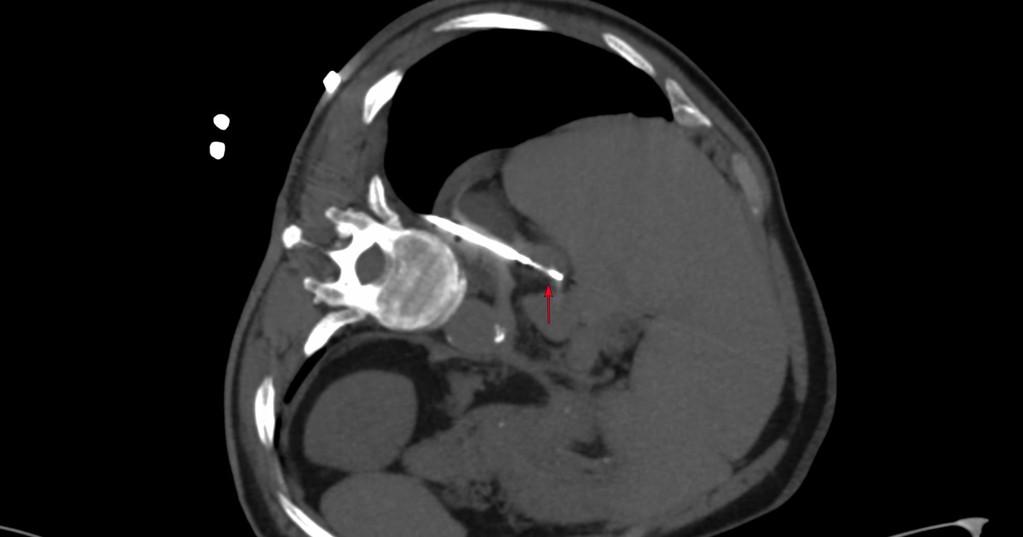 Case 172 - Right Adrenal Gland Biopsy Using an Ipsilateral Up Approach with Hydrodissection