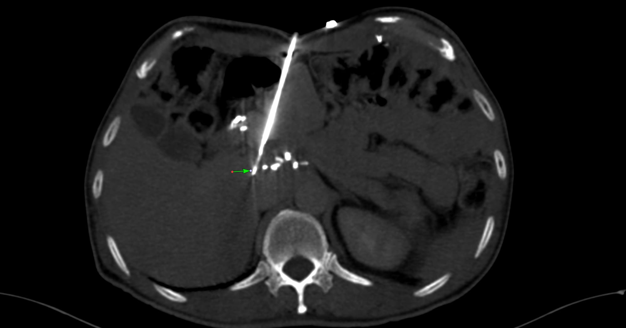 Case 173 - Periportal Node Biopsy in a Post-Whipple’s Abdomen - The Power of a Blunt-Tip Needle