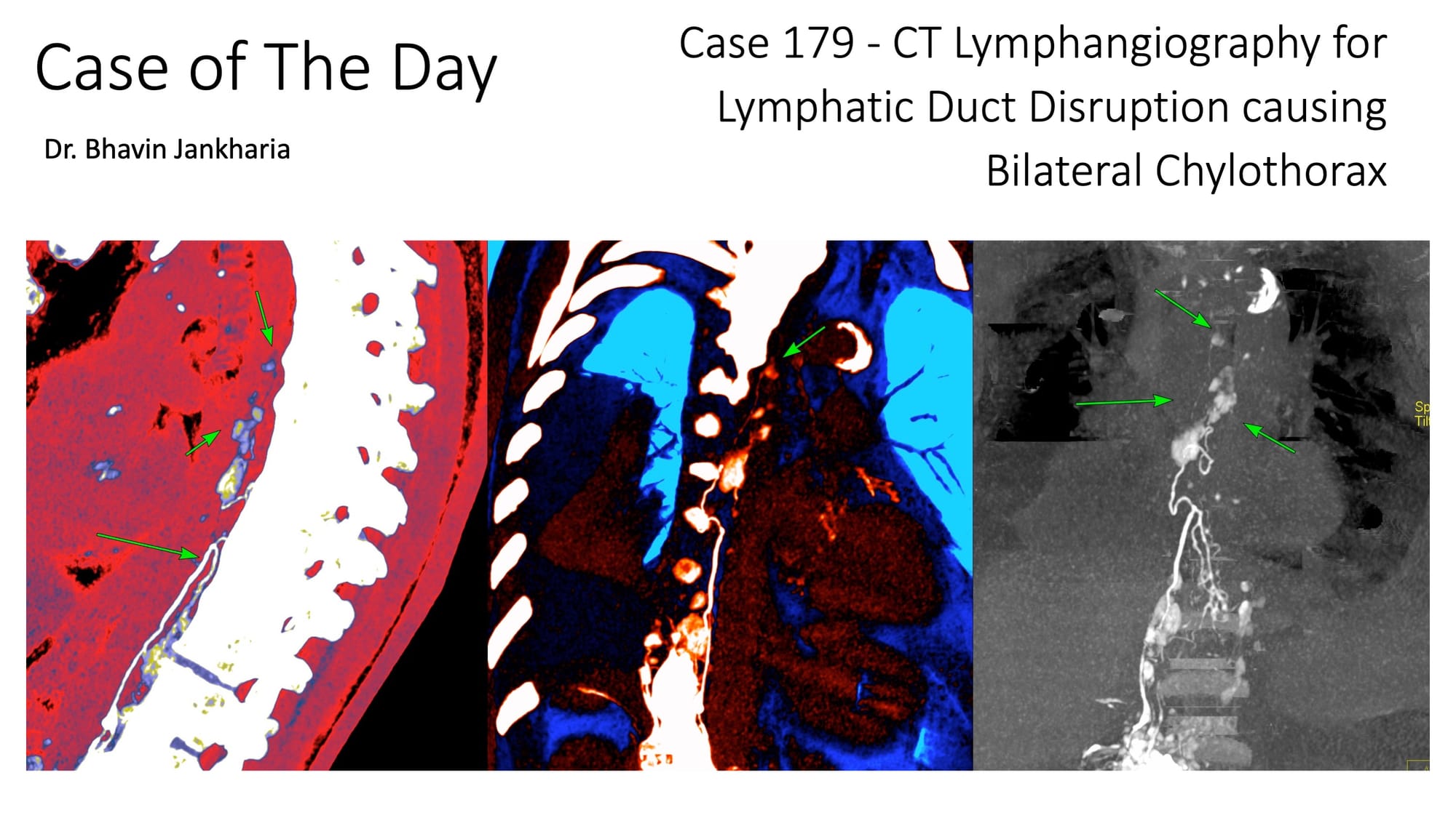 COD 179 - CT Lymphangiography for Lymphatic Duct Disruption and Bilateral Chylothorax