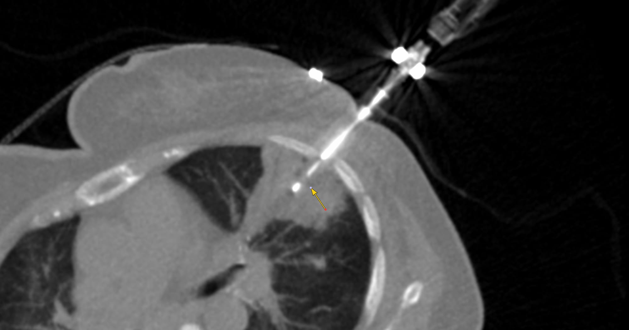 Case 174: Left Upper Lobe Consolidation - The "Parallel-to-Vessel" Approach to Avoid Hemorrhage