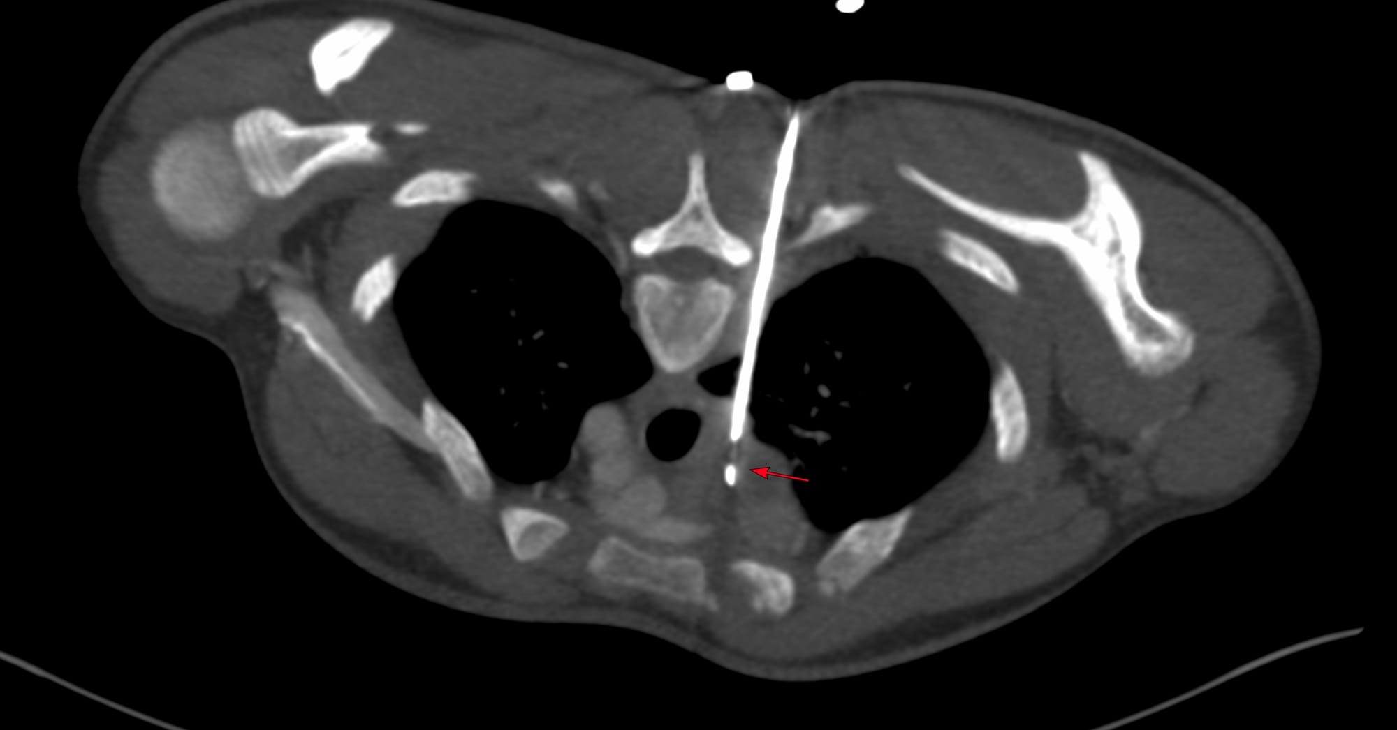 Case 178 - Transparenchymal Paratracheal Node Biopsy