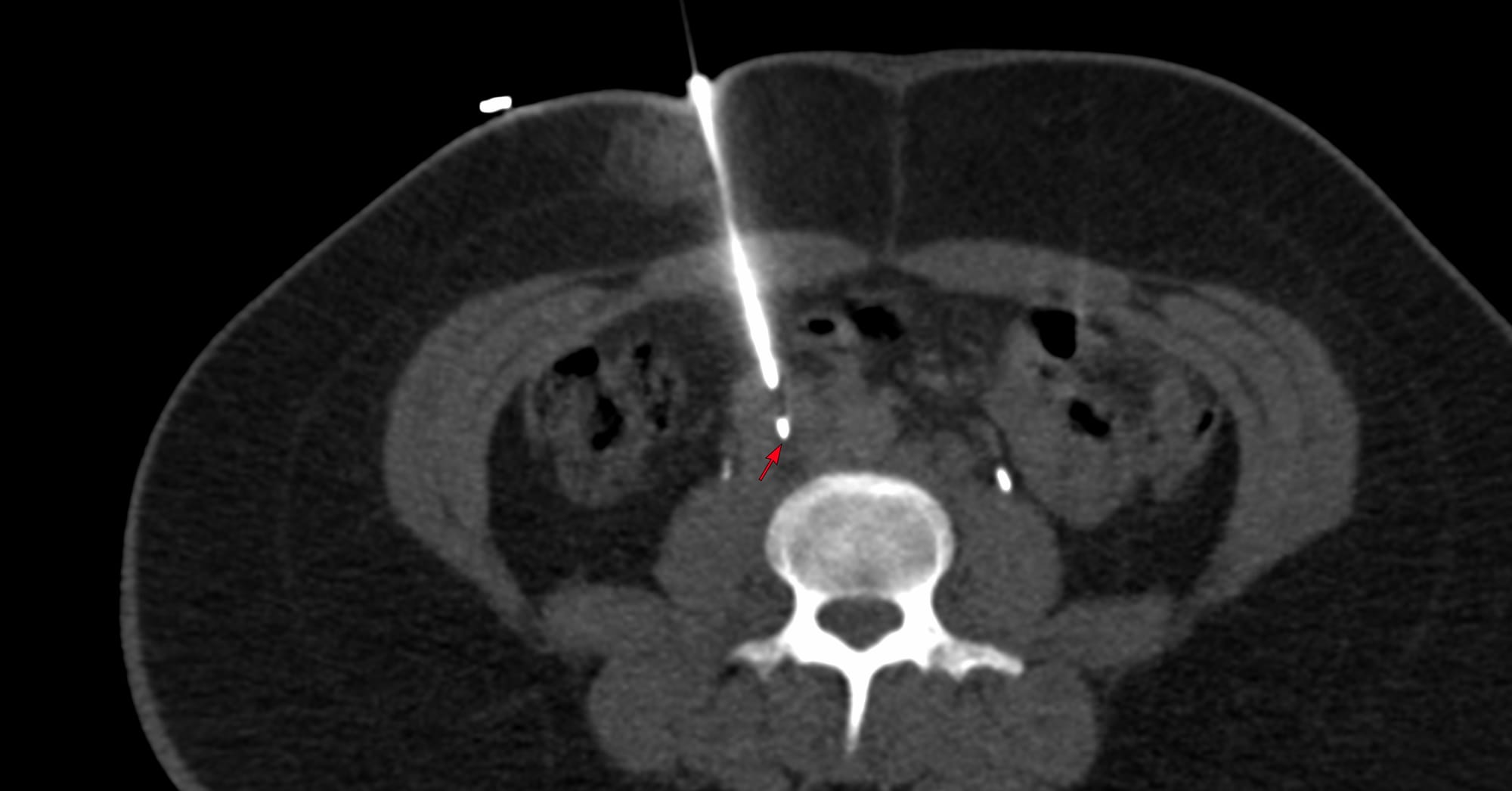 Case 176 - Supine Anterior Approach for an Aortocaval Node