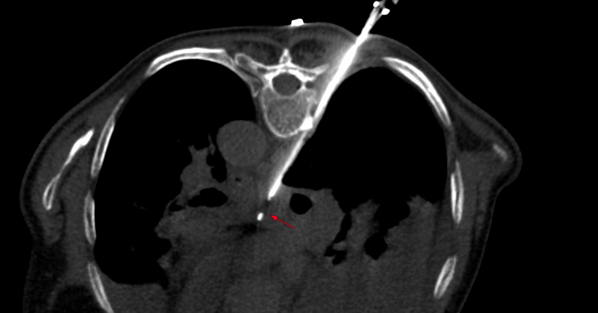 Case 179 - Extrapleural Subcarinal Node Biopsy with Hydrodissection