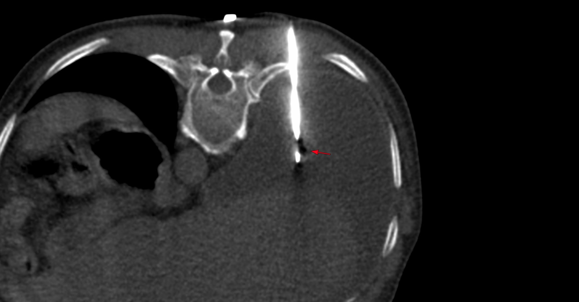 Case 177 - Transpleural Biopsy of Lung Lesion