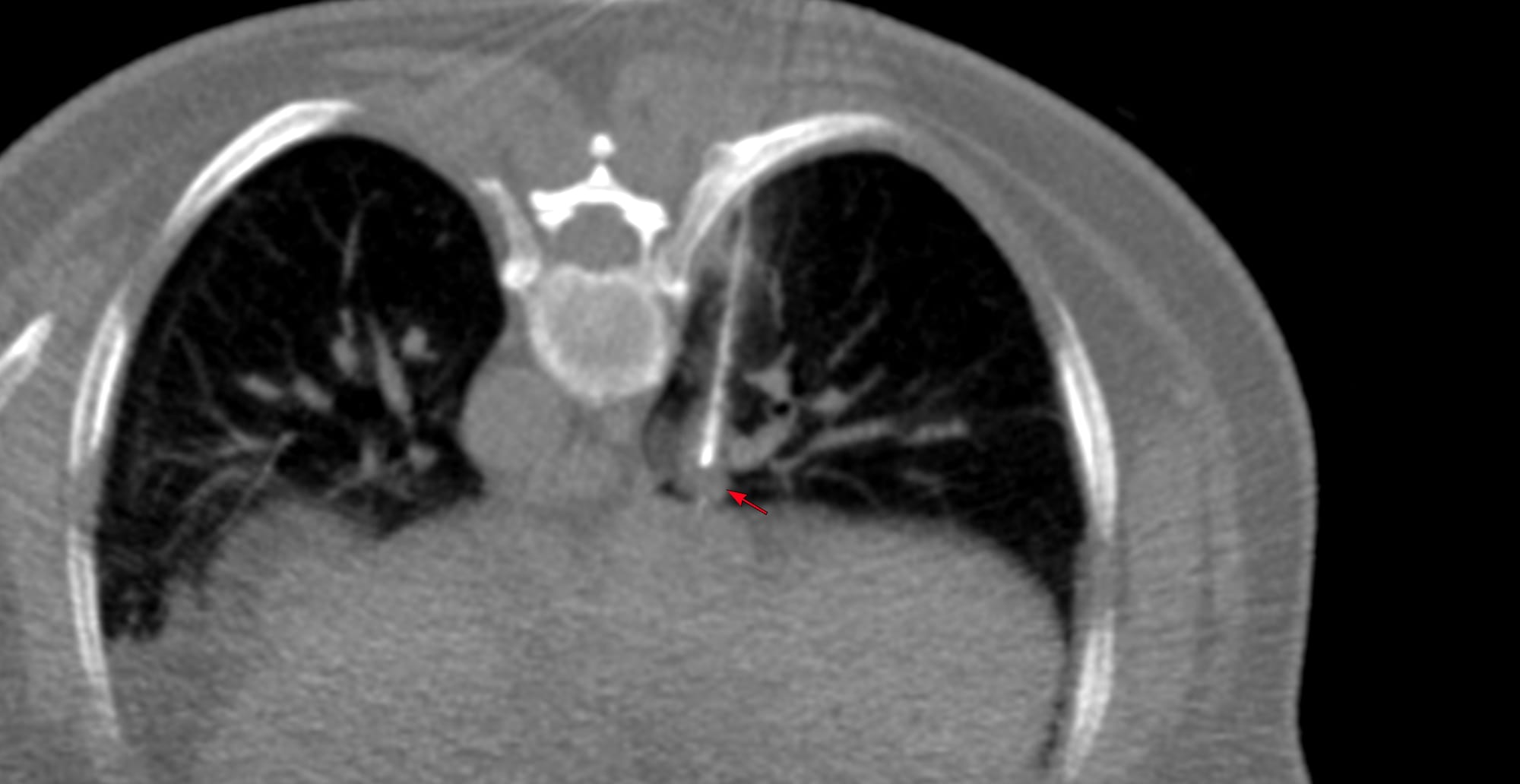 Case 182 - Small Nodule Lung Biopsy - A Procedure that Radiologists Can Still Do for a Few More Years