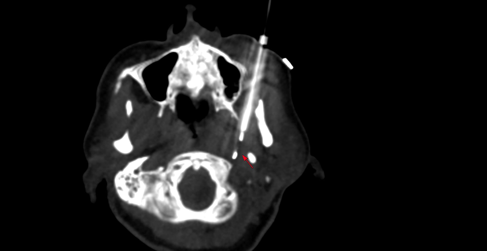 Case 181 - Transbuccal, Paramaxillary Approach for a Carotid Space Mass using the Styloid Process a Fixed Point