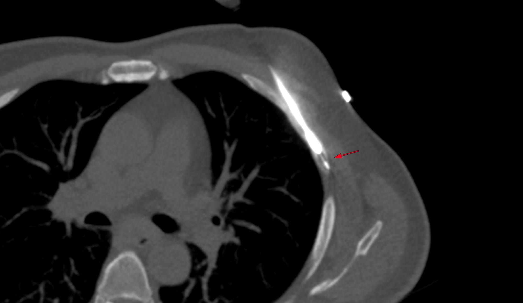 Case 180 - Long-Axis Biopsy of a PSMA-Positive Rib Lesion