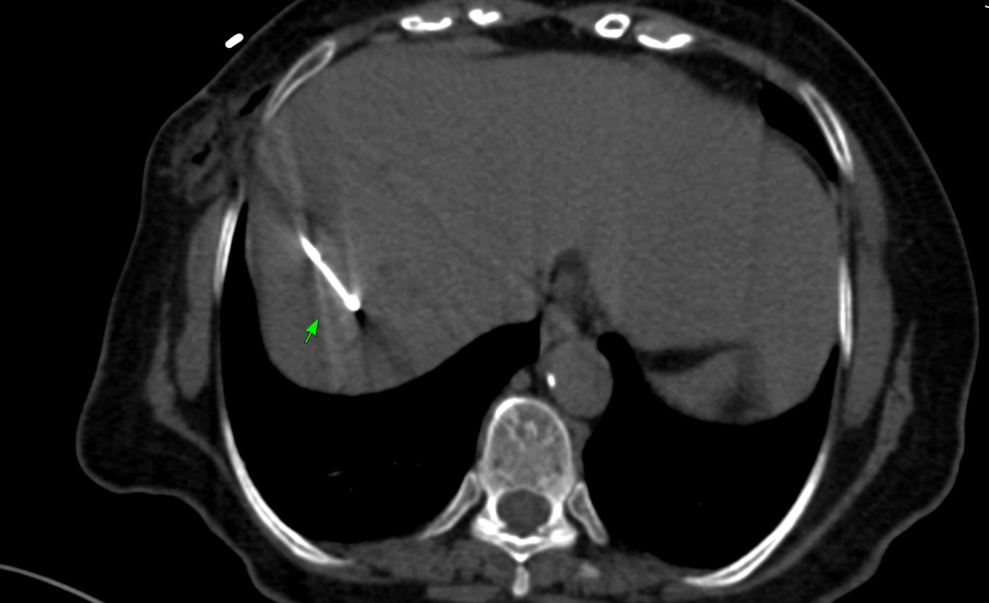 Case 183 - Gantry Angulation to Access a Segment 8 Liver Lesion Using Biliary Radicles as Fixed Points