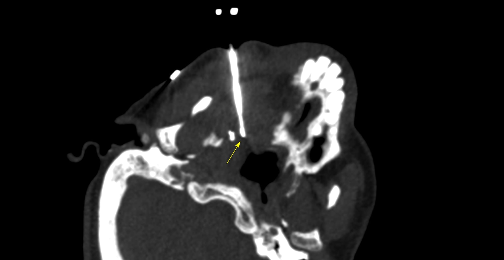Case 185 - The Paramaxillary Approach