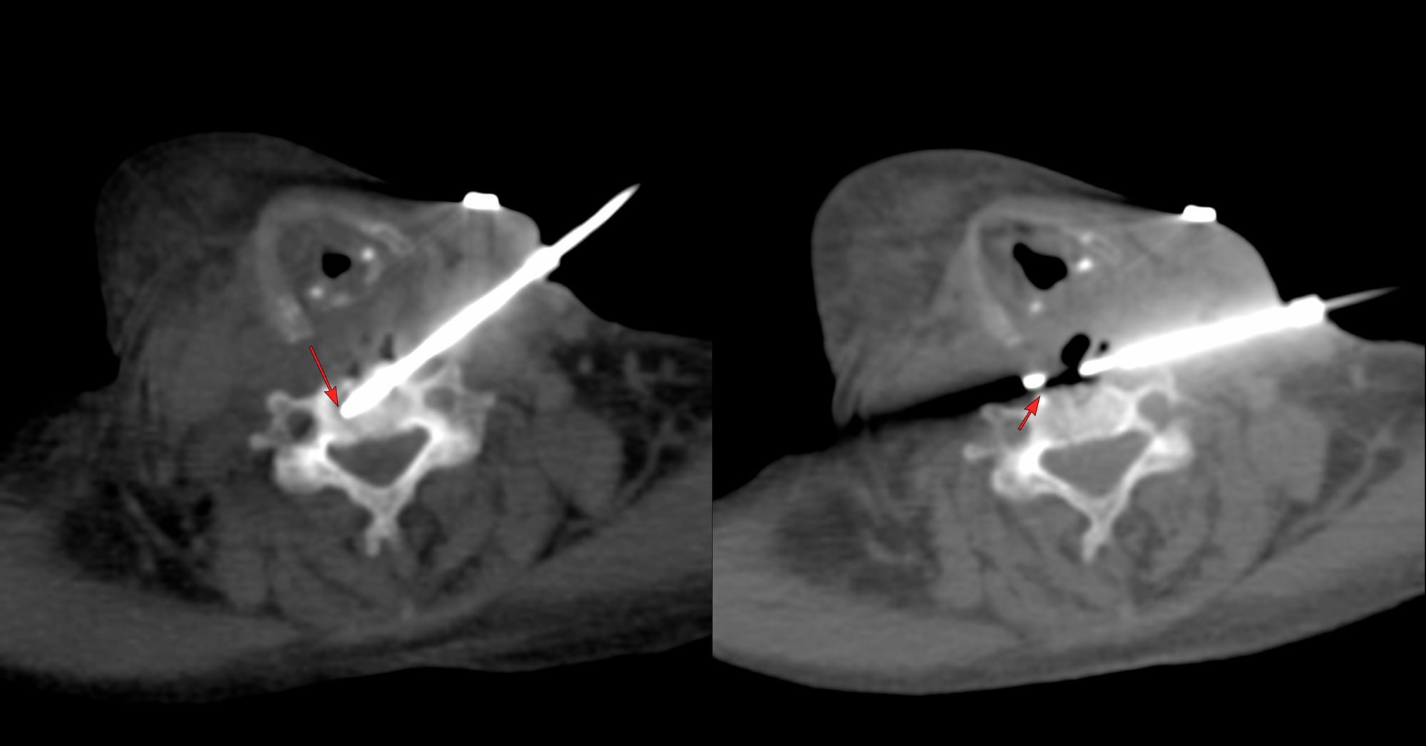 Case 184 - C3-C5 Infectious Spondylitis Biopsy - Retrocarotid Approach