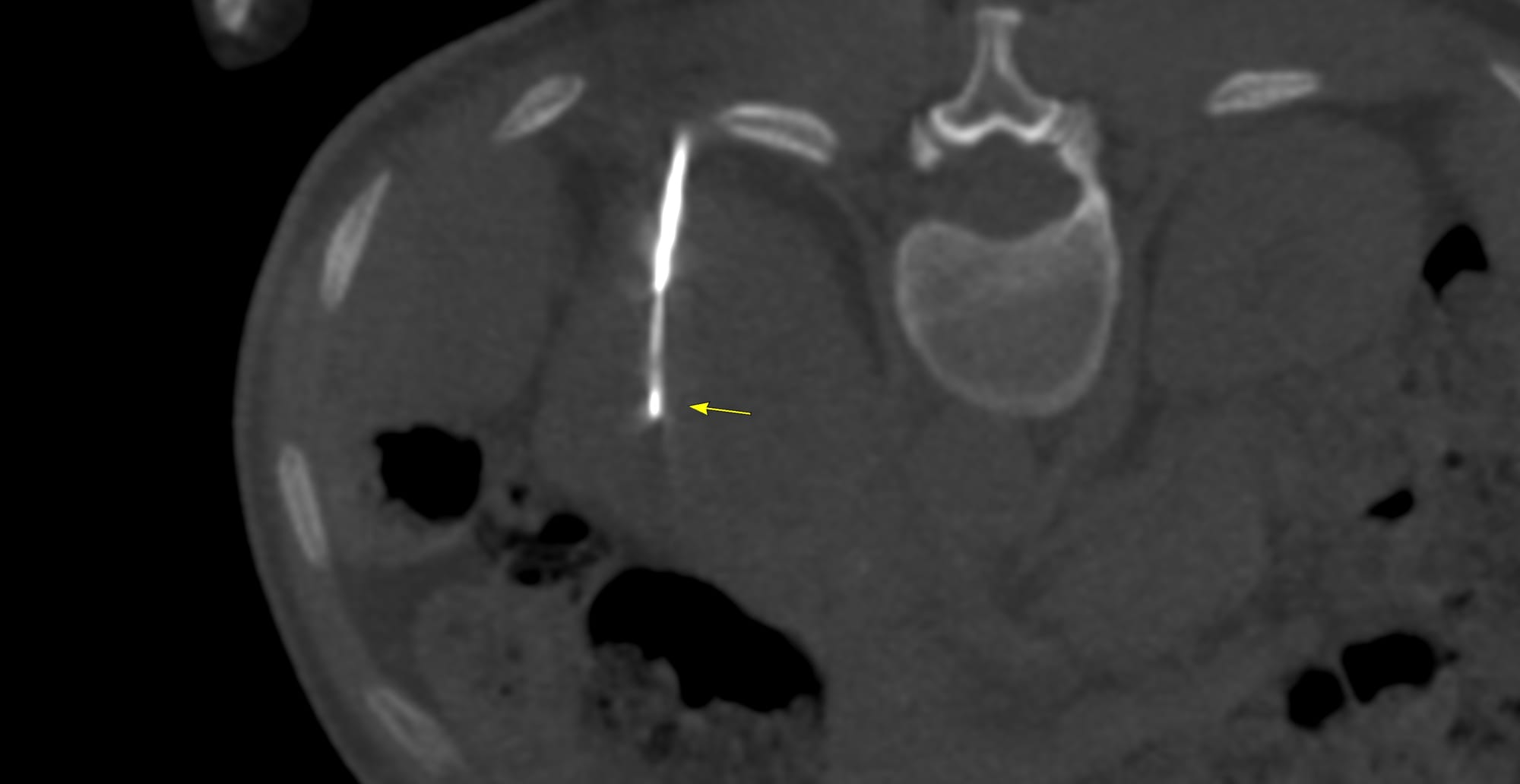 Case 186 - Biopsy of Pheomochromocytomas and Paragangliomas (PPGL)