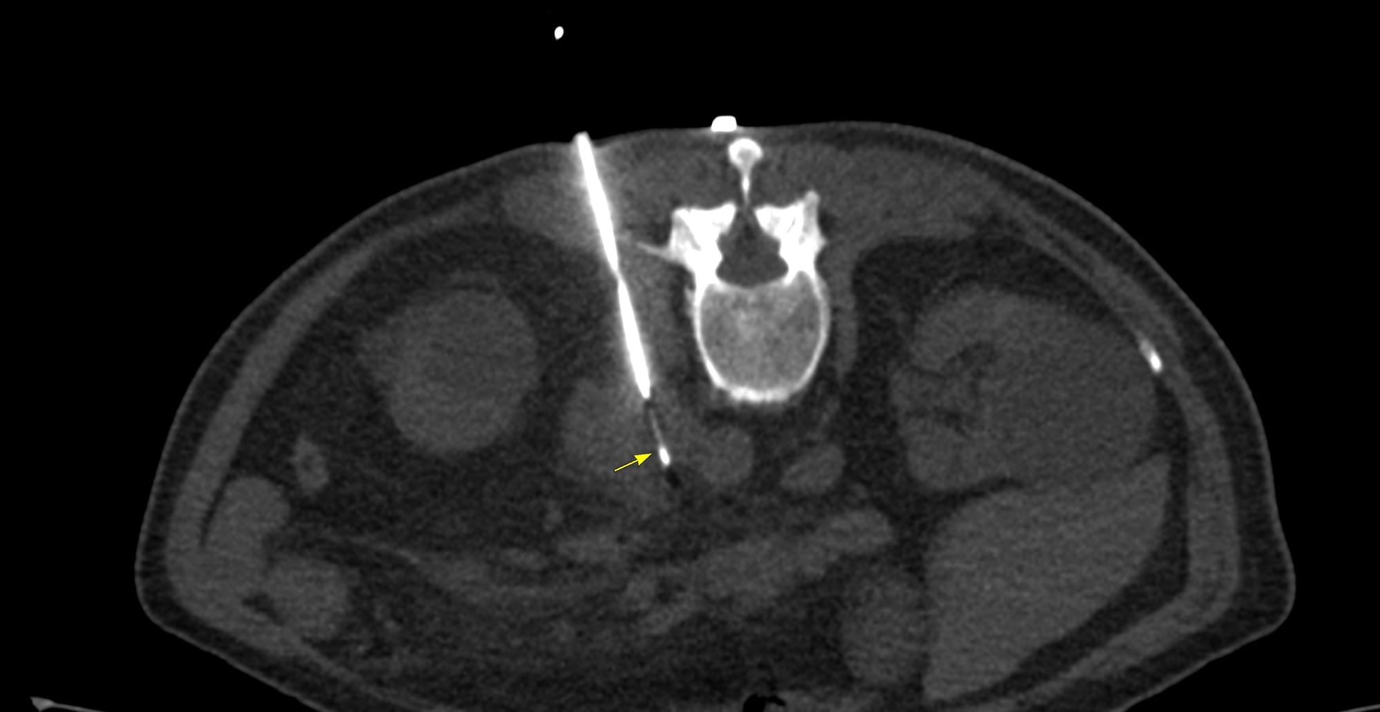 Case 187 - Retroperitoneal Para-Aortic Node Biopsy - Prone, Paravertebral, Posterolateral Approach