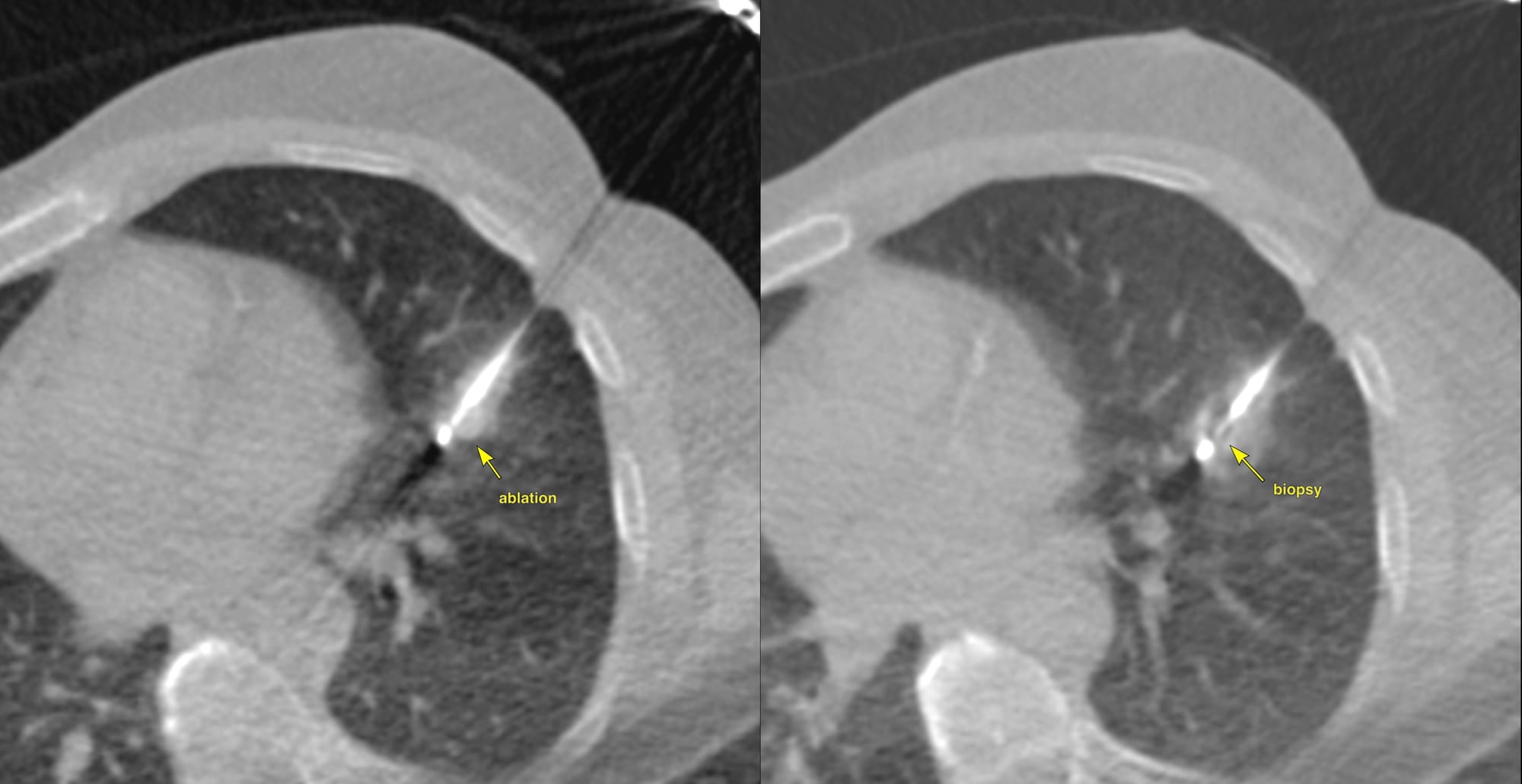 Case 189 - Biopsy Before Ablation, or After?
