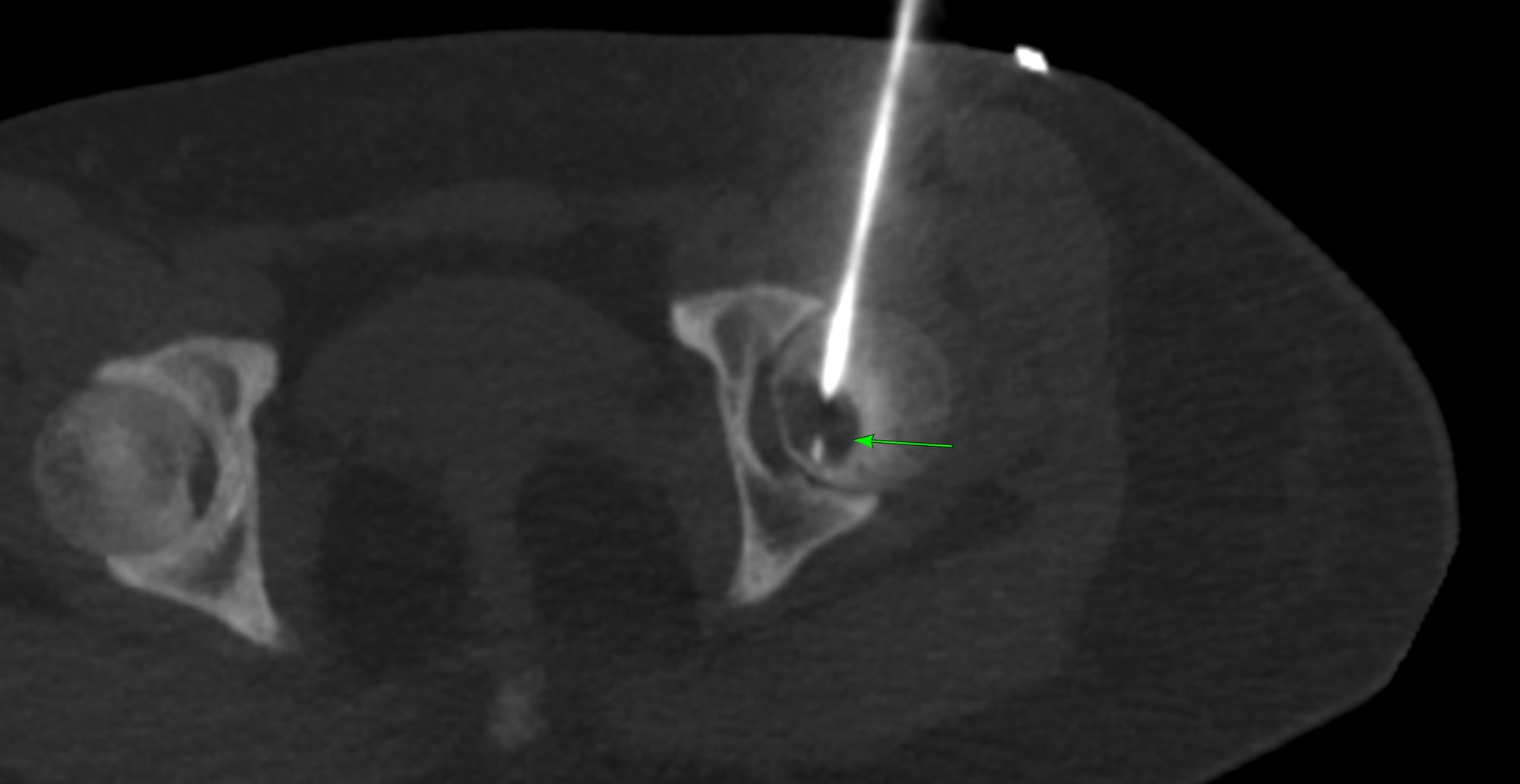 Case 188 - Femoral Head Osteolytic Lesion Biopsy with a Supine Anterior Transcapsular Approach