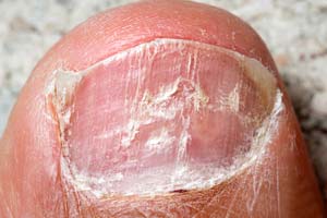 Ongles secs, fendus ou cassants