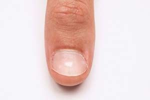 4. Taches blanches