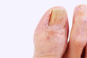 Ongles jaunes