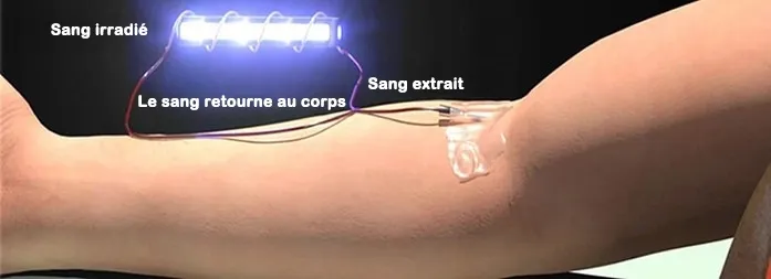 Types d'irradiation du sang