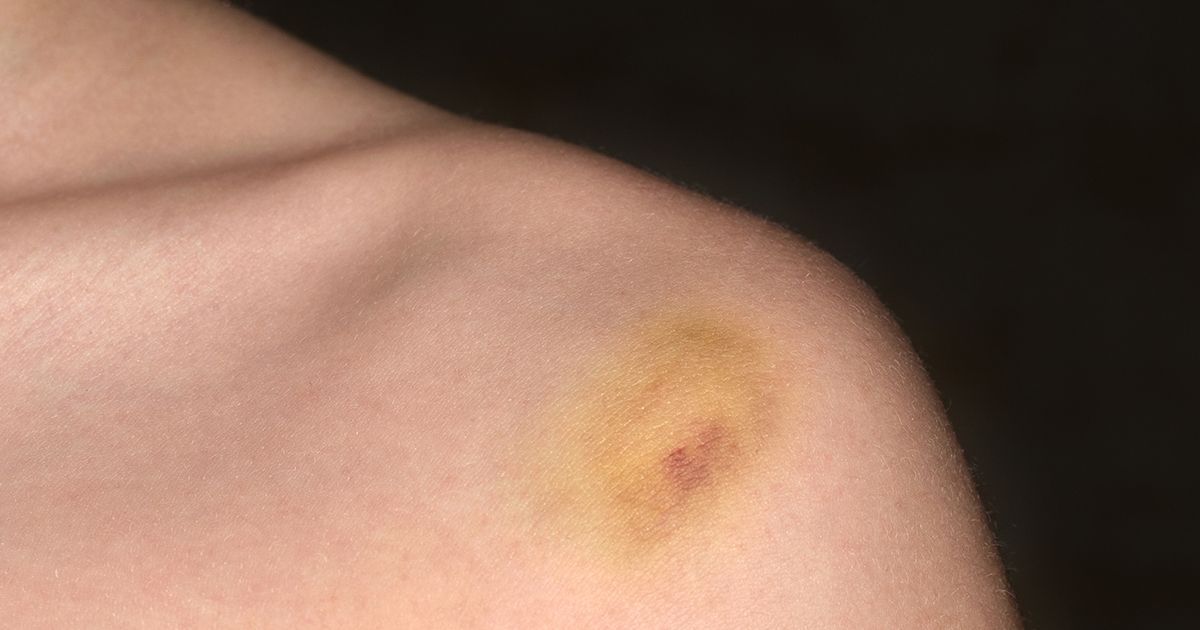 Ce type d'ecchymose doit-il vous inquiéter ?