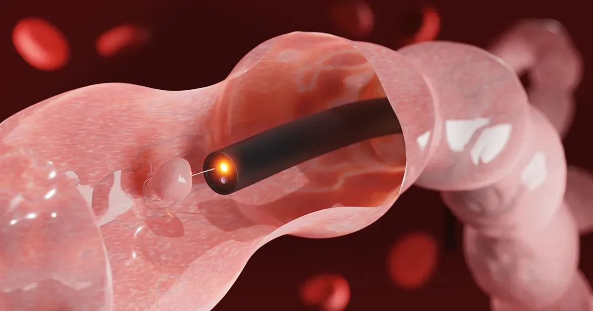 Devez-vous subir une coloscopie ?