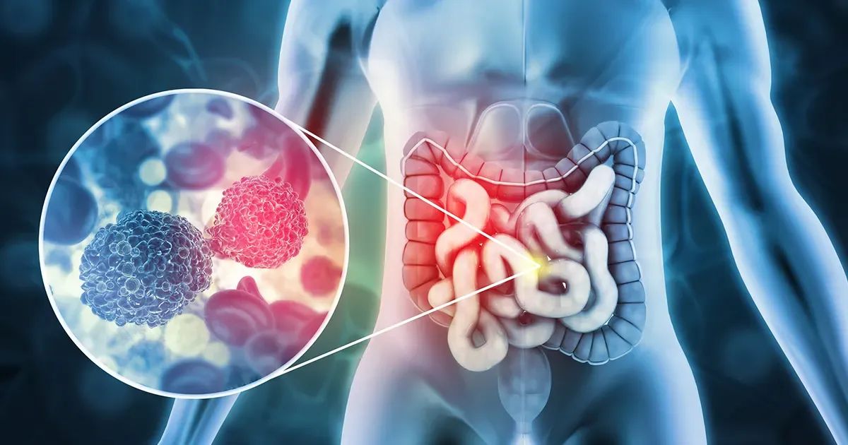 Ce que votre côlon pourrait révéler sur votre santé