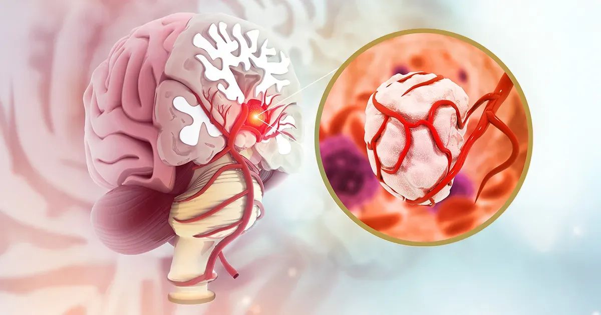 Certains symptômes peuvent signaler une tumeur sans que vous le sachiez