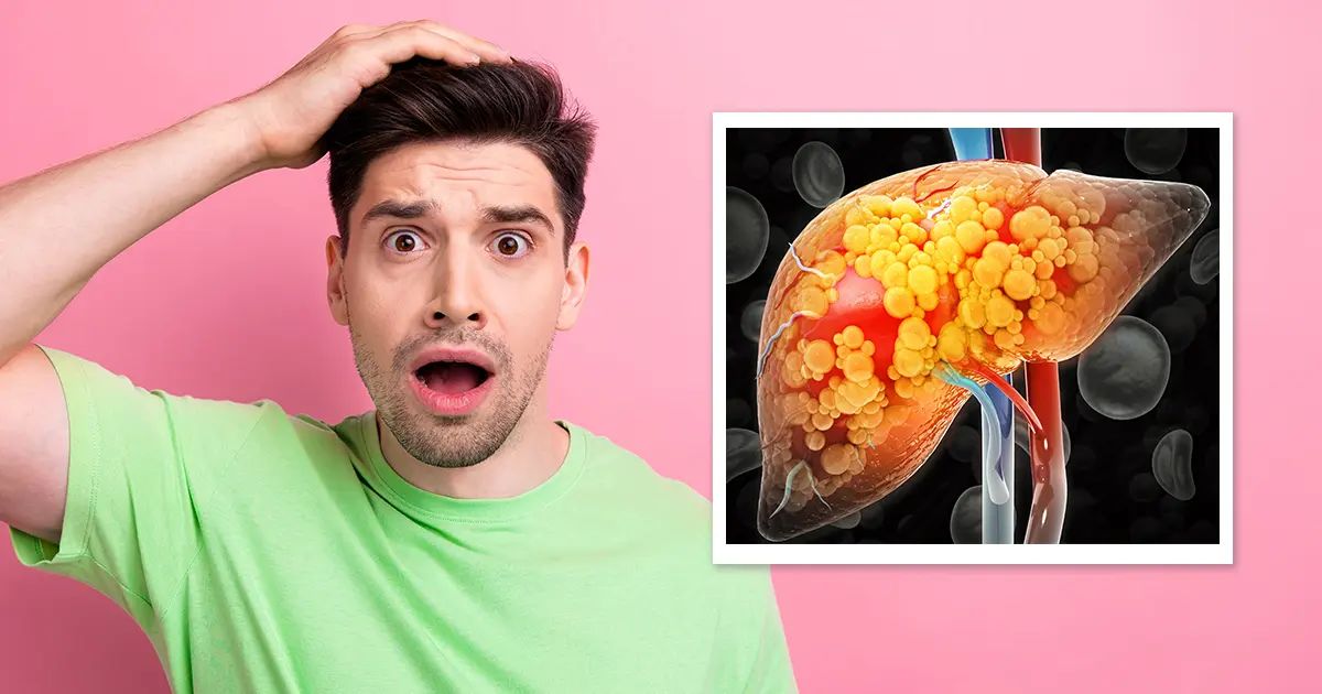 Un trouble fréquent du foie aux conséquences bien différentes