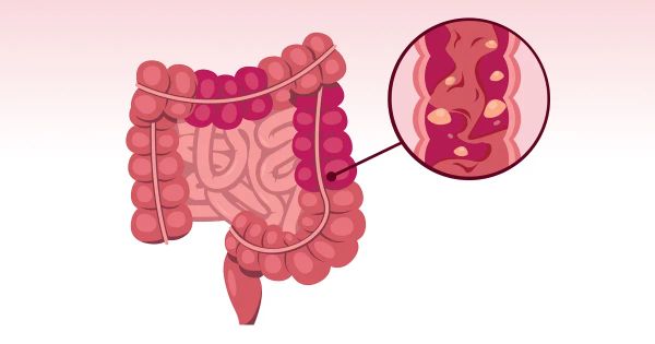 Votre système digestif est en crise ? Voici comment l’apaiser