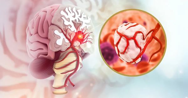 Certains symptômes peuvent signaler une tumeur sans que vous le sachiez