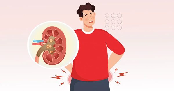 Un type de calcul rénal peu connu, plus dangereux qu’il n’y paraît