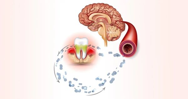 Démence : pourquoi votre santé buccale compte plus que vous ne le pensez