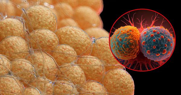 Cette graisse favorise la progression du cancer en silence