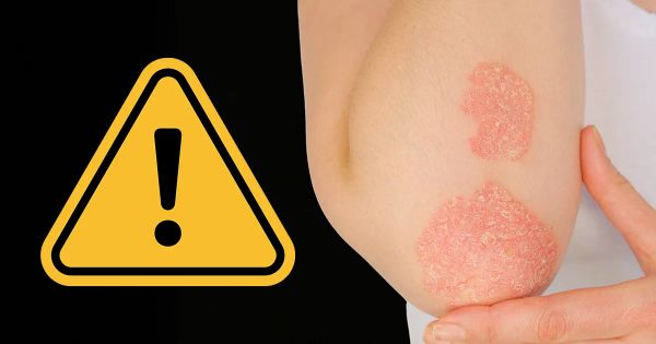 Une habitude alimentaire courante pourrait suffire à faire apparaître des plaques rouges