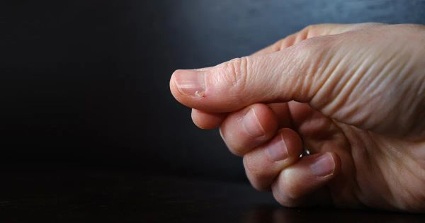 Ces petites peaux gênantes peuvent revenir sans cesse si vous ne faites pas attention