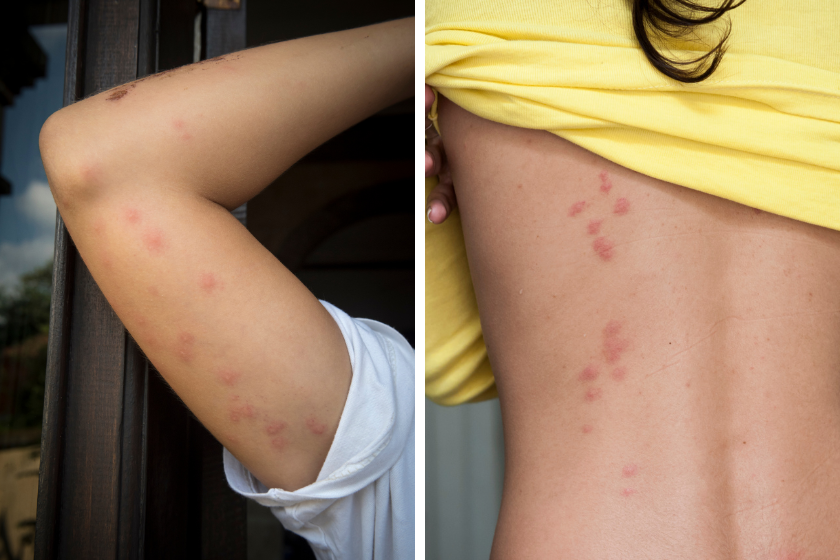 picaduras de chinches