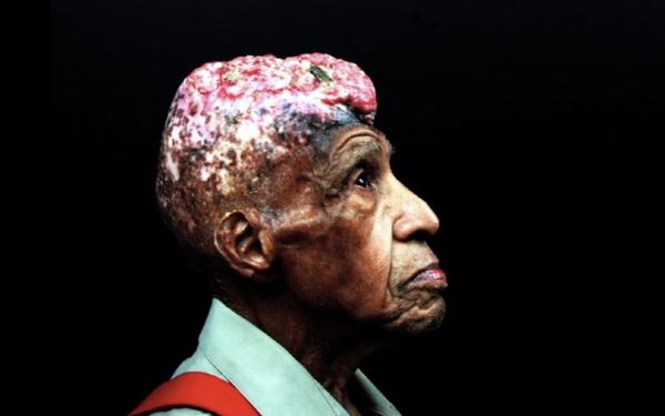 Inside the Radiation Program That Targeted Black Children