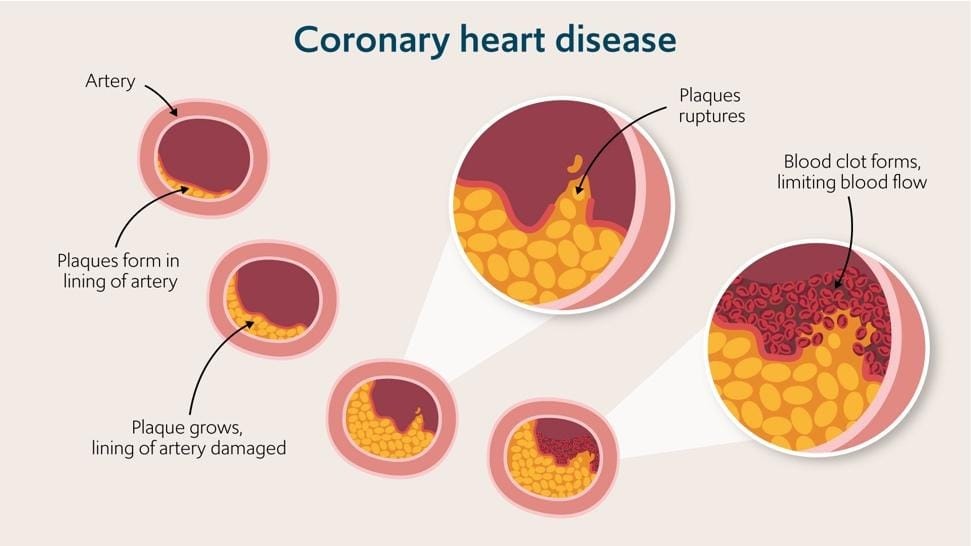Can microplastics contribute to heart disease?