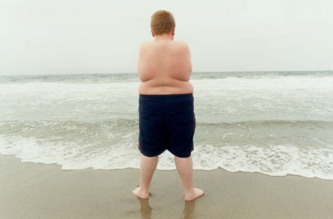 The Childhood Obesity Crisis in America: What Parents Need to Know About Treatment Options for Teens