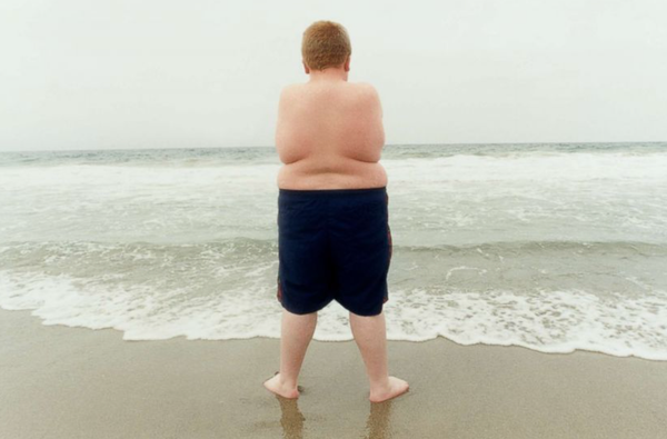 The Childhood Obesity Crisis in America: What Parents Need to Know About Treatment Options for Teens