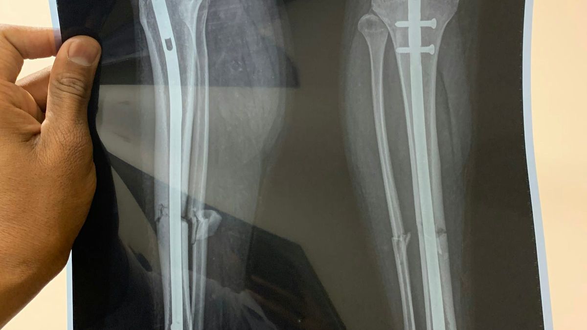 Apollo's $20 billion for DePuy Synthes is roughly what J&J paid for Synthes alone.