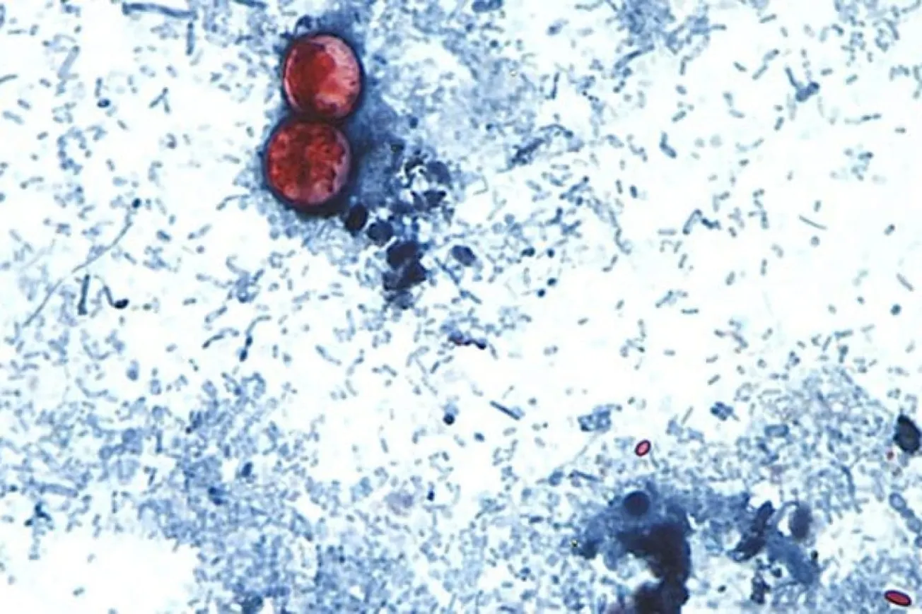 US Cyclosporiasis Outbreak Surpasses 18,200 Suspected Cases